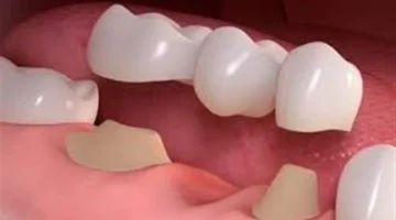 خطوات تركيب الأسنان: كيف تؤثر كل مرحلة على نجاح العلاج وراحة المريض